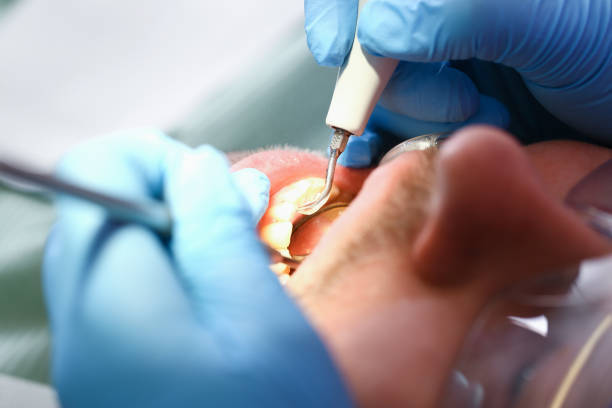 Best Emergency Wisdom Teeth Removal in Manhattan, MT